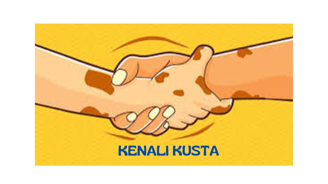 Kusta Bukan Kutukan, Jangan Takut Lapor